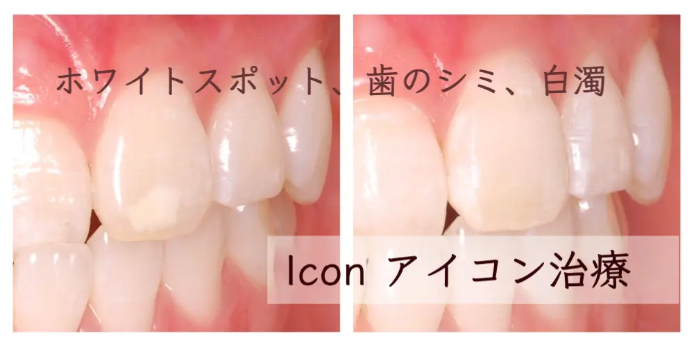 ホワイトスポット、歯のシミ、白濁 Iconアイコン治療
