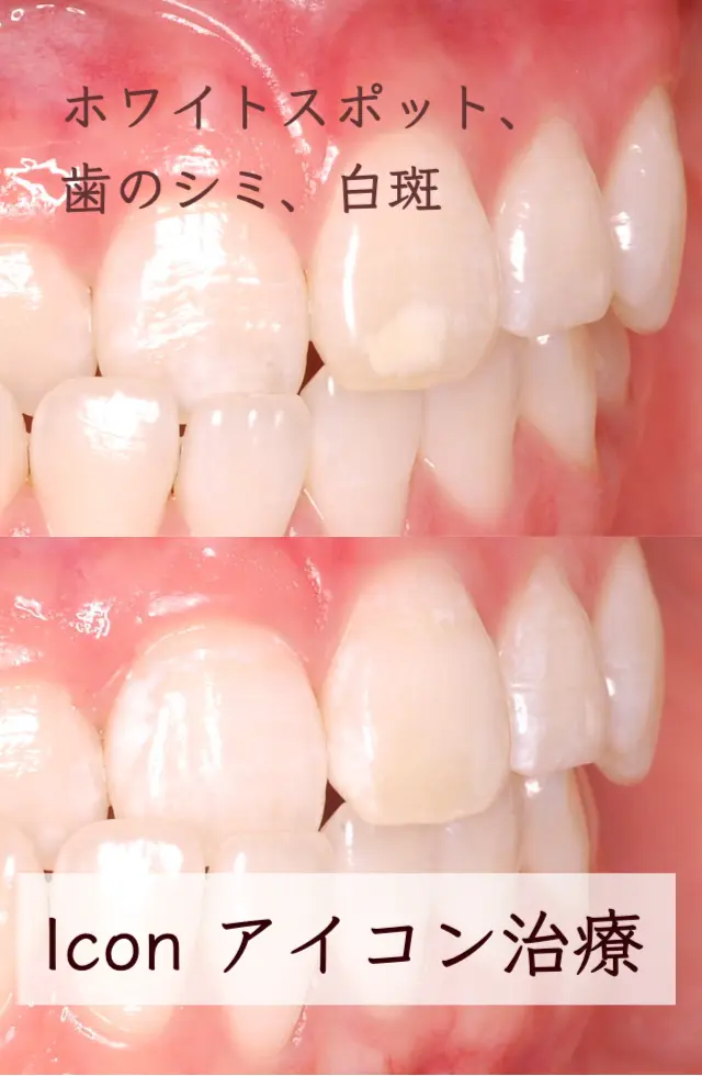 ホワイトスポット、歯のシミ、白濁 Iconアイコン治療