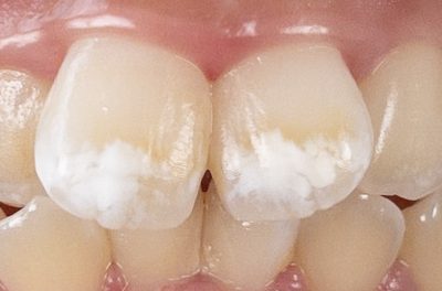 前歯のホワイトスポット