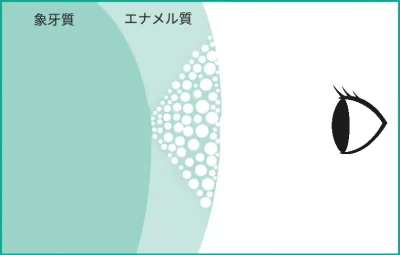 ホワイトスポットが白く見える原因